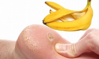 Koring banane za liječenje plantarne bradavice
