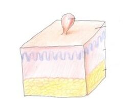 kako se riješiti papiloma na tijelu