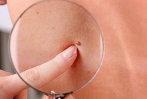 razlozi za pojavu papiloma na ljudskom tijelu