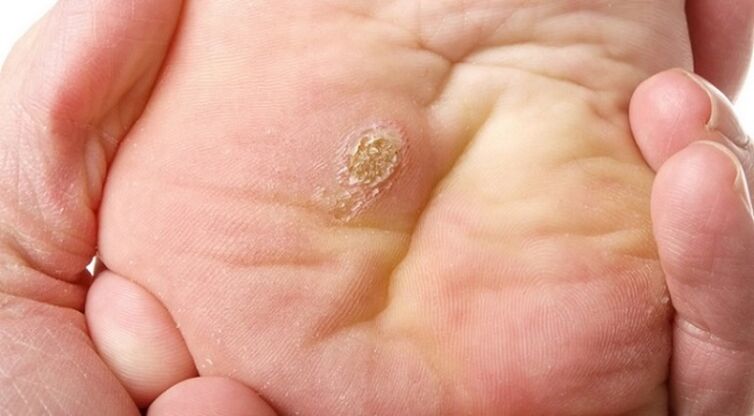 plantarni i ravni papilomi