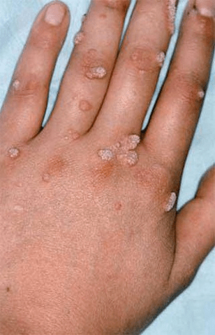 papiloma na rukama