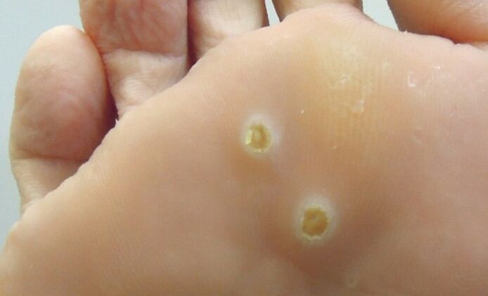 plantarni papilomi na stopalu