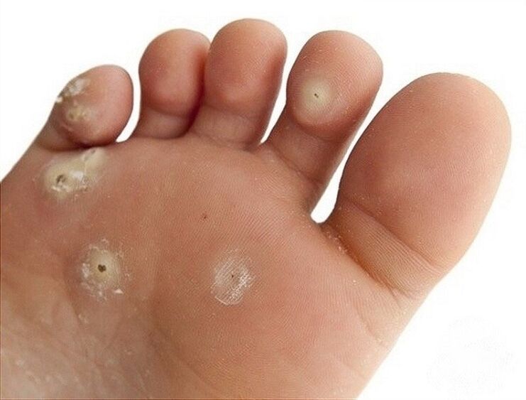 plantarna bradavica