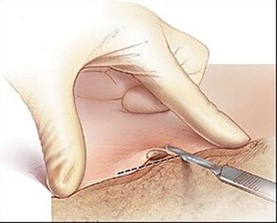 Kirurško izrezivanje bradavice